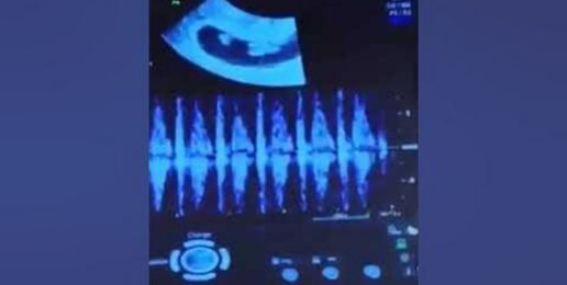 This is the heartbeat of a 7 week old preborn baby. #shorts
